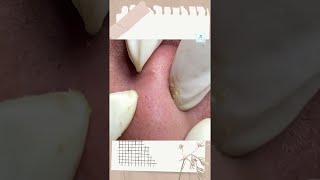 Big Cystic Acne Blackheads Extraction Blackheads amp Milia Whiteheads Removal Pimple Popping shorts [upl. by Ahseinar869]