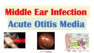 Middle Ear Infection Acute Otitis Media  Causes Symptoms Diagnosis Treatment [upl. by Cecilia]