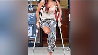 The beautiful woman has an amputated leg and walks on one leg with one crutch amputee [upl. by Kathryne75]