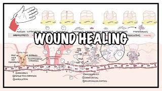 Wound Healing  Stages of healing and pathology [upl. by Attecnoc31]