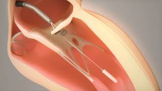 Transcatheter Mitral Valve Chord Repair by Pipeline Medical [upl. by Natale]