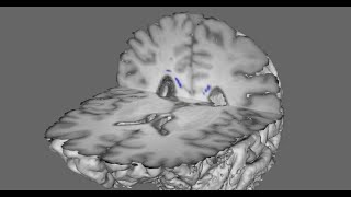 Soccer heading and the brains gray matterwhite matter interface [upl. by Olra]