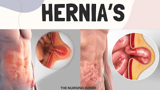 HERNIAs  Types  Causes  Risk factors  Clinical features Management [upl. by Nashom466]