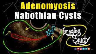 Adenomyosis with Nabothian Cysts  Ultrasound  TVS  Case 255 [upl. by Col331]