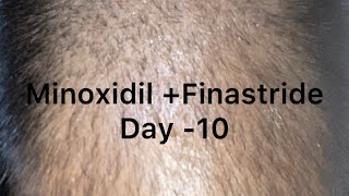 Minoxidil result day 10 [upl. by Swehttam]