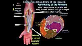 Compartment Syndrome Of The Forearm  Everything You Need To Know  Dr Nabil Ebraheim [upl. by Allerim824]