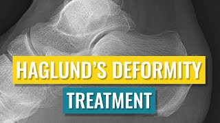 Haglunds Deformity Treatment [upl. by Amarette]