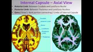 Brain Internal Capsule Demonstration Video  Sanjoy Sanyal [upl. by Sanyu]