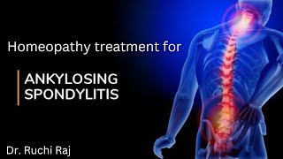 HOMEOPATHY TREATMENT FOR ANKYLOSING SPONDYLITIS [upl. by Llenrap721]