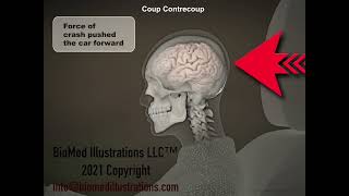 Coup Contrecoup Whiplash Brain Injury [upl. by Orthman502]