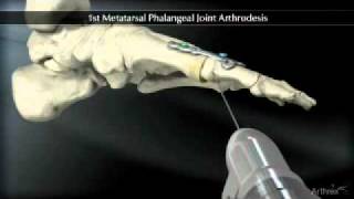 1st Metatarsal Phalangeal Joint Arthodesis [upl. by Fital45]