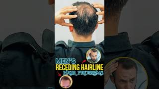 Hair Loss Receding Hairline Treatment [upl. by Llenoil601]