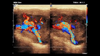 Pleomorphic Adenoma of Parotid Gland  Ultrasound  Doppler  Case 05 [upl. by Ettolrahs]