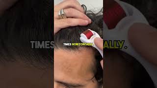 HOW TO USE A DERMAROLLER FOR HAIR LOSS alopecia skincare hair [upl. by Aicila521]