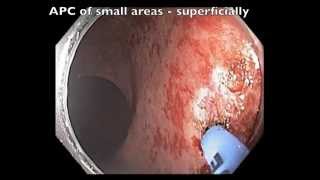 Rectum  Radiation Telangectasia in Prostate Cancer after Radiation [upl. by Gaspar]