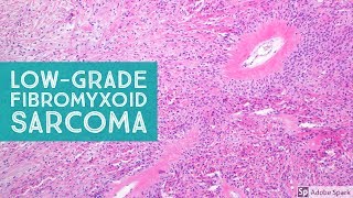 LowGrade Fibromyxoid Sarcoma Evans Tumor 101Explained by a Sarcoma Pathologist [upl. by Enelrae316]