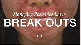 The Ultimate Guide to Managing Post Pico Laser Breakouts [upl. by Aniale707]