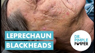 Blackhead Blackheads amp Blackheads Extended Leprechaun Blackheads [upl. by Alimat]