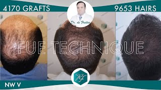 Injerto Capilar Técnica FUE – 4170 Grafts 9653 Pelos – Dr Rafael de Freitas [upl. by Artemus]