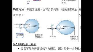 HKDSE 生物科 概念重溫篇：第15課（8） 眼睛的毛病 [upl. by Nnomae]