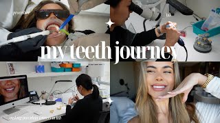 I GOT VENEERS  The Making of Porcelain Veneers BTS Start to Finish Process VLOG  The Dental Room [upl. by Adranoel]