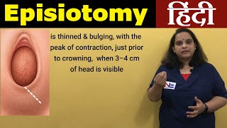 Episiotomy in Hindi  Perineotomy  Nursing Lecture [upl. by Salas]