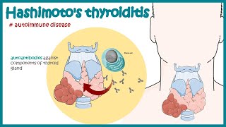 Hashimotos thyroiditis  Autoimmune diseases [upl. by Einaled]