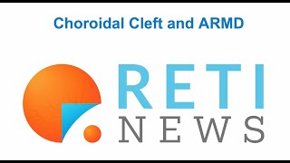 Choroidal Cleft and nARMD activity [upl. by Amsed238]