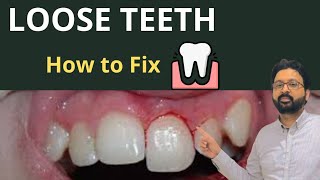 Why Your Teeth Feel LOOSE amp How to Treat TOOTH Mobility [upl. by Asenab]