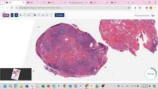 Epithelioid hemangioma aka angiolympoid hyperplasia with eosinophilALHE [upl. by Yleak]