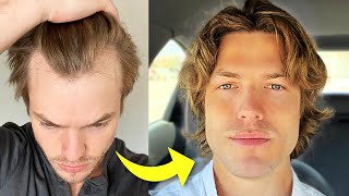 My Turkey Hair Transplant Results After 1 Year  Before amp After [upl. by Jepum]