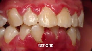 Treatment of Periodontal Gum Disease [upl. by Atat124]