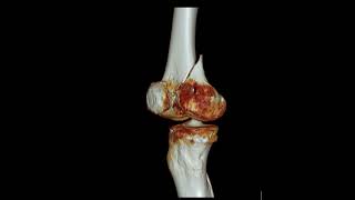 Femur medial condyle fracture [upl. by Cristine179]