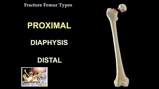 Fracture Femur Types  Everything You Need To Know  Dr Nabil Ebraheim [upl. by Simara]