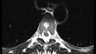 Typical and Atypical Hemangioma [upl. by Dragelin]