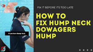 How to FIX Hump Neck  1 Simple Exercise [upl. by Zampino]