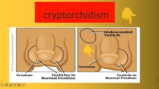 Cryptorchidism [upl. by Alya396]