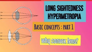 HYPERMETROPIA  BASICS to ADVANCED [upl. by Fogarty]