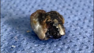 Ear Wax Removal  107  Fungal infection revealed after ear wax plug removal [upl. by Kcirdahs]