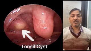 Right Tonsil Cyst  गले में दर्द और टीस का कारण [upl. by Rusticus]