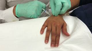 Radiesse hands rejuvenation by Dr Yuriy Yagudin [upl. by Corson]