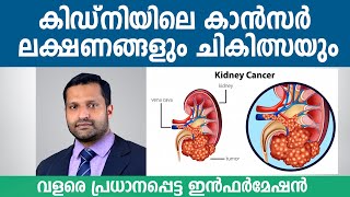 Renal Cell Carcinoma RCC  Symptoms Causes and Treatment  Dr Vishnu Gopal  Aster MIMS Kannur [upl. by Neelhtakyram]