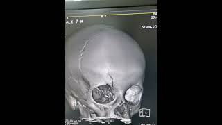 Right Frontal Bone Fracture of Skull  Fracture seen on 3D View of Skull  Medical Imag DrGreenSide [upl. by Seen]