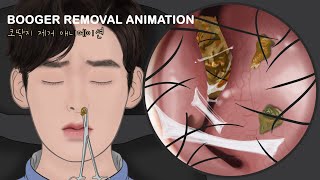 ASMR Endoscopic Nose Secretion Removal Animation  Piercing nose full of boogers [upl. by Hannej618]