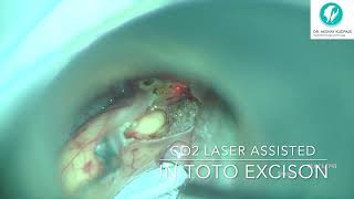 Valecullar cyst  Transoral laser surgery assisted excision [upl. by Salesin943]