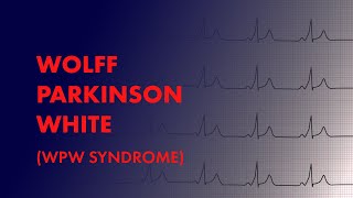 Wolff Parkinson White WPW Syndrome  EKG ECG Interpretation [upl. by Solotsopa]