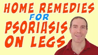 Home Remedies For Psoriasis On Legs  Remedy Psoriasis on your Legs [upl. by Nanoc701]