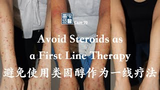 Avoid Steroids as a First Line Therapy 避免使用类固醇作为一线疗法 [upl. by Herzel]