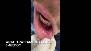 Terapia LASER Afta [upl. by Yreneh]