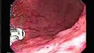 Video Endoscopy of Severe gastritis [upl. by Ak967]